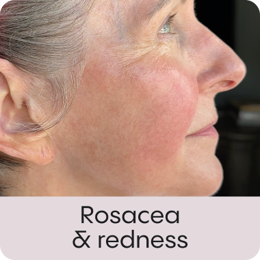 Rosacea és bőrpír